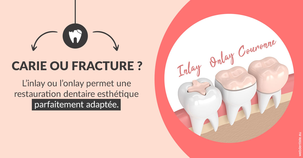 https://selarl-marche-soligni.chirurgiens-dentistes.fr/T2 2023 - Carie ou fracture 2