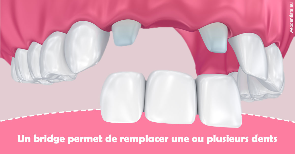 https://selarl-marche-soligni.chirurgiens-dentistes.fr/Bridge remplacer dents 2