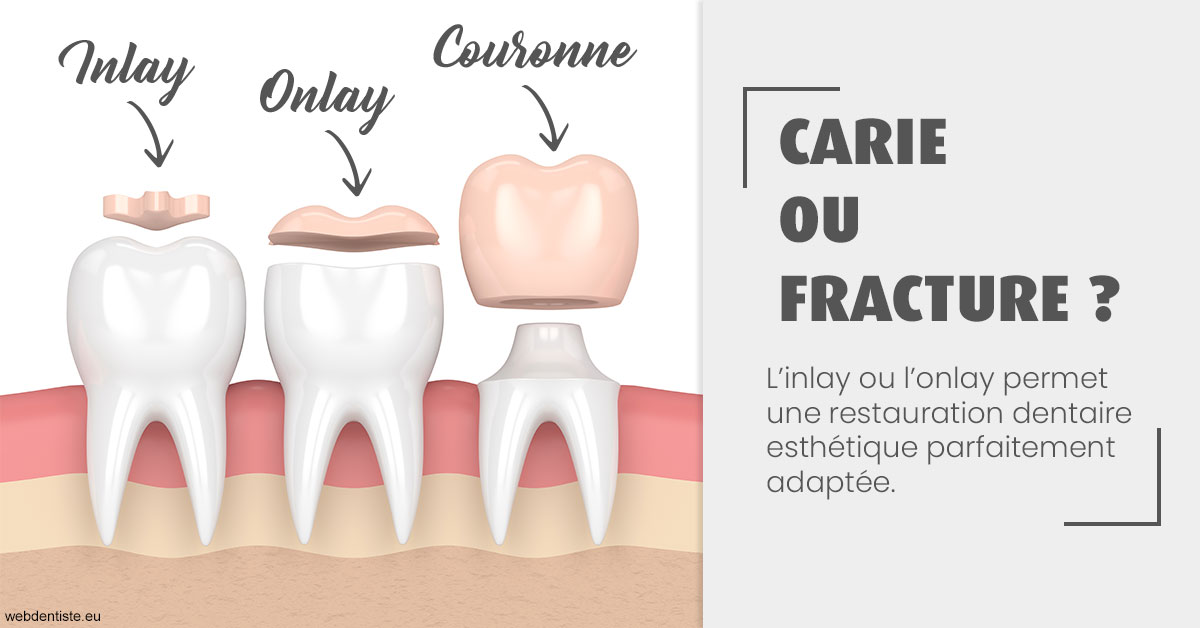 https://selarl-marche-soligni.chirurgiens-dentistes.fr/T2 2023 - Carie ou fracture 1