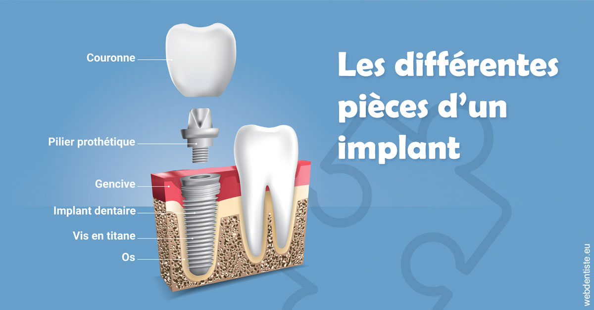 https://selarl-marche-soligni.chirurgiens-dentistes.fr/Les différentes pièces d’un implant 1